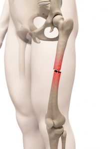 compensation for misdiagnosis of fracture